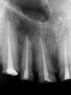endodonticky ošetřené horní frontální zuby