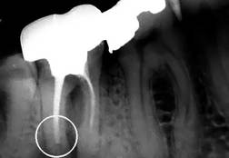 Nedostatečně zaplněné kořenové kanálky zubů 47 a 46