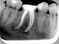 endodontické ošetření stoličky