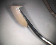 keramická fazeta sloužící k estetické korekci nevyhovující barvy či tvaru zubu