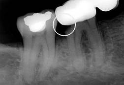 RTG vyšetření pomůže odhalit skryté zubní kazy