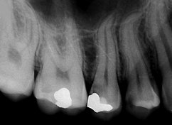 RTG vyšetření pomůže odhalit skryté zubní kazy
