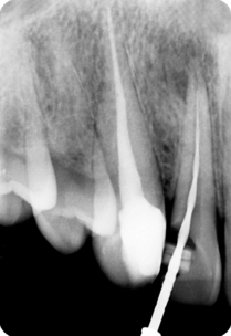 RTG snímek endodontického ošetření