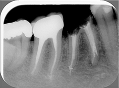 Reendodoncie: zuby 47 a 46 po nově provedeném endo ošetření