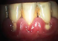 Parodontitída a nános zubního kamene
