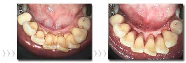 1 - dolní frontální zuby se zubním kamenem. 2- po odstranění zubního kamene