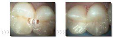 Vlevo: zubní kazy na premolárech. Vpravo: ošetření fotokompozitem