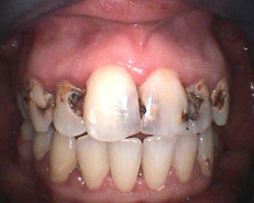 Zubní kaz