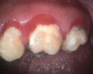 Zubní plak