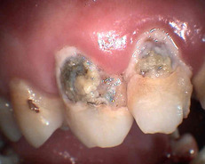 zubní plak a zubní kazy