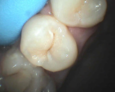 skrytý zubní kaz (na boční stěně zubu)