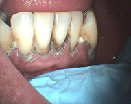 zubní kámen