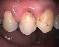 zánět dásní způsobený usazeninami zubního kamene