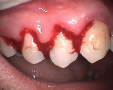 zánět dásní se při mechanickém podráždění projevuje intenzivním krvácením dásní