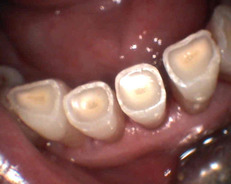 abraze předních zubů