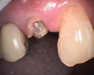 zubní kořen před nasazením kořenové dostavby