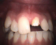 stav po úrazu - ulomený zub
