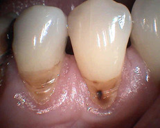 krčkové defekty často způsobené nepřiměřeným tlakem zubního kartáčku