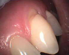 1Oprava krčkového defektu na zubu 23 kompozitem (Gradia direct A2).jpg