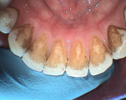 zubní povlaky a pigmentace před odstraněním