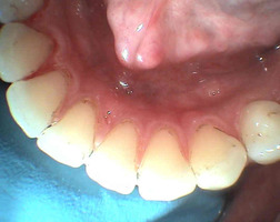 Stav po odstranění zubní pigmentace(airflow)