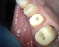 dostavba zkažených zubních pahýlů přímými čepy
