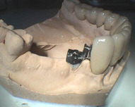 fixní část na kterou se upevňuje zásuvná snímatelná protéza (model)