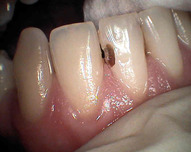 zubní kaz na zubu 41