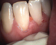 zubní kaz na zubu 41 po ošetření fotokompozitem (Gradia direct A2)